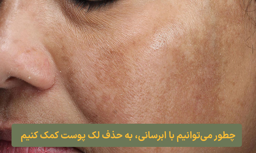 چطور می‌توانیم با ابرسانی، به حذف لک پوست کمک کنیم ارایشی کلبه نیک