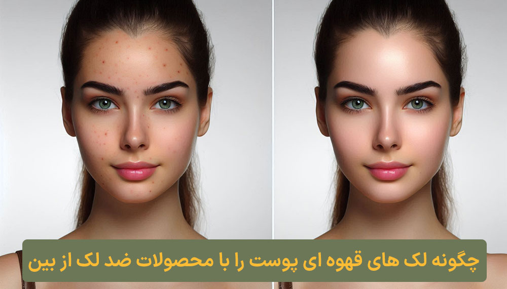 چگونه لک های قهوه ای پوست را با محصولات ضد لک از بین ببریم؟ کلبه نیک